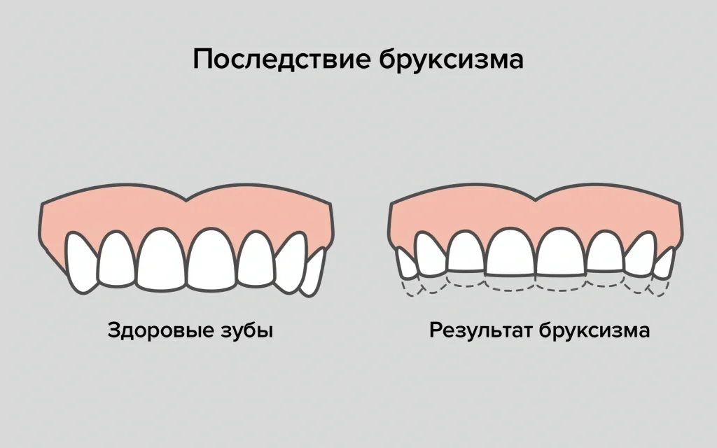 Бруксизм: последствие