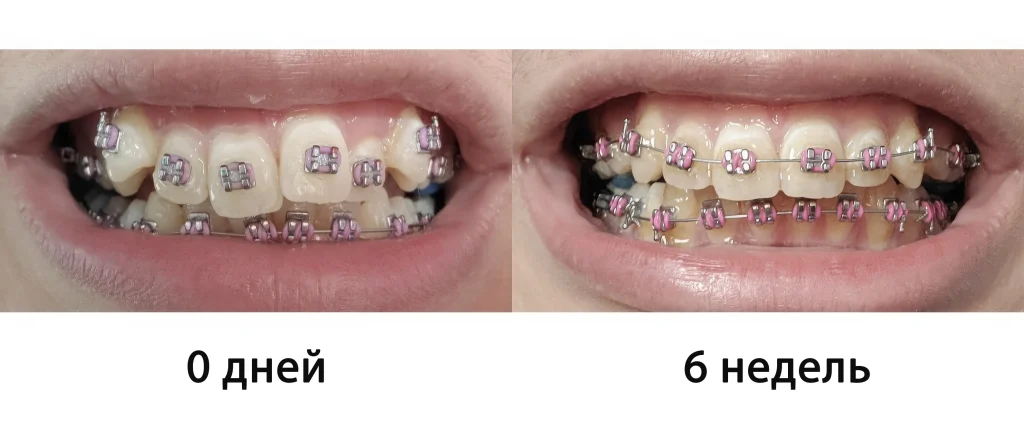 Фото пациента с брекетами через 6 недели
