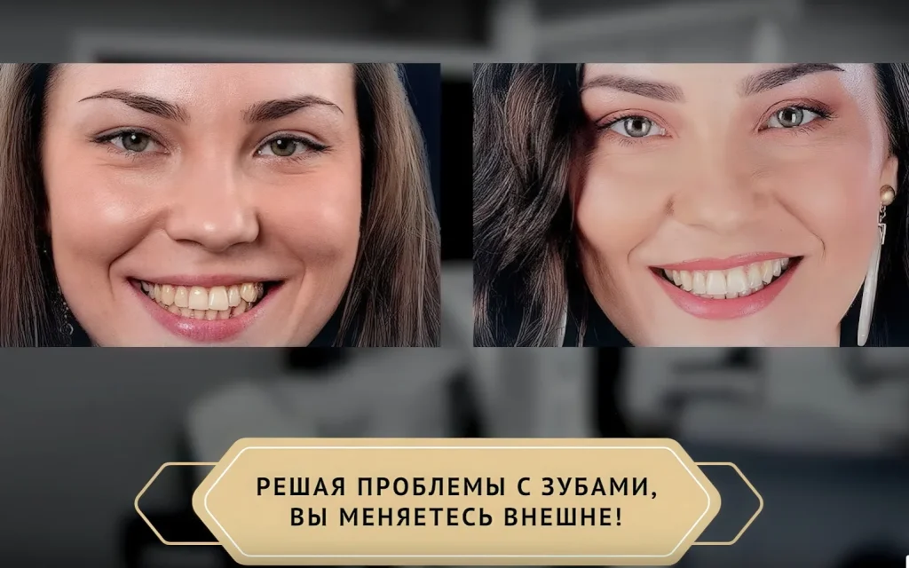 эстетическая реставрация винирами