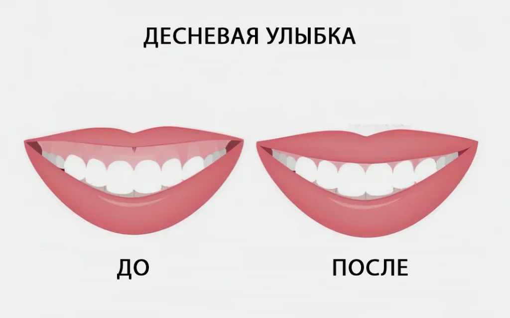 десневая улыбка