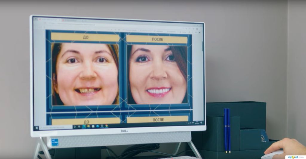 Омоложение внешности через стоматологию